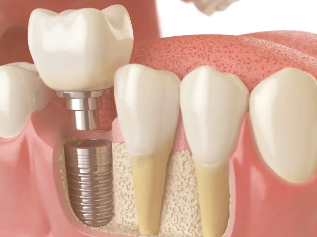 6 Side Effects Of A Dental Implant Surgery