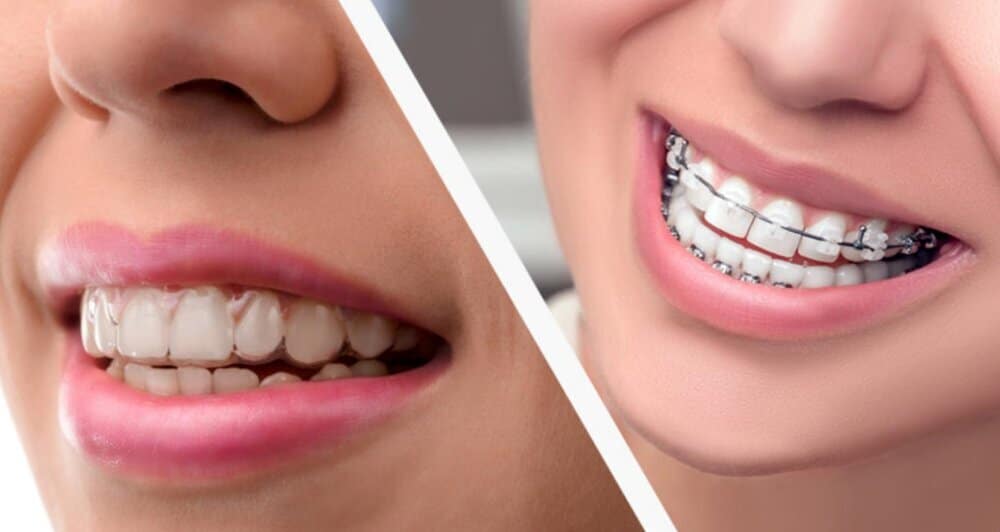 Can Invisalign Work On Crooked Teeth