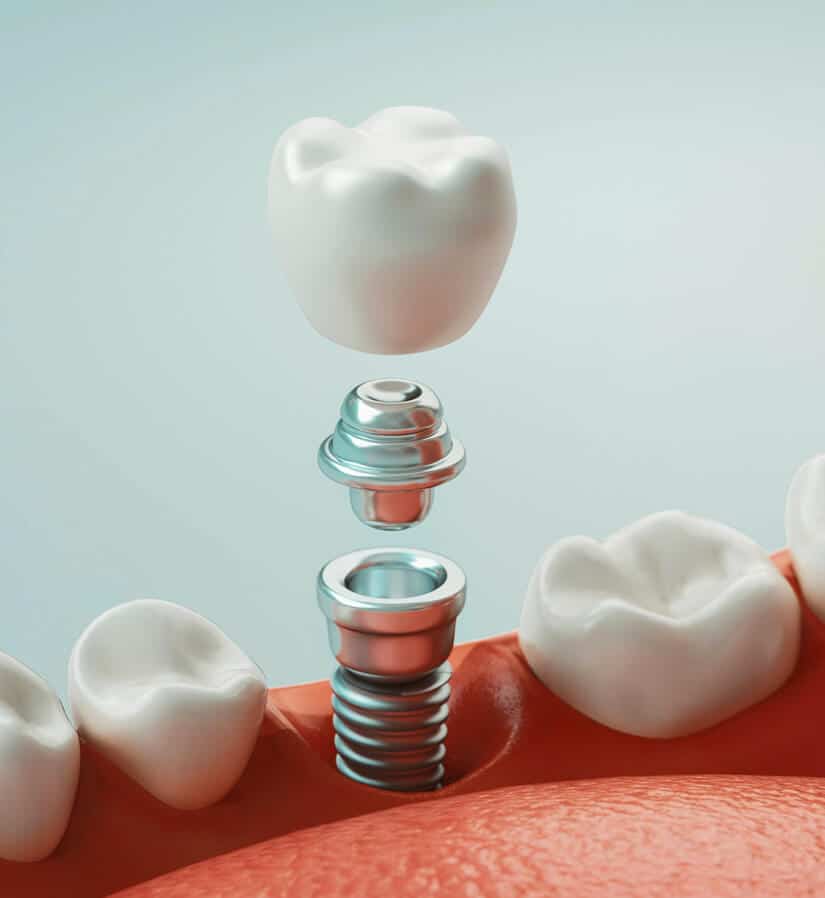 dental implant Thornton