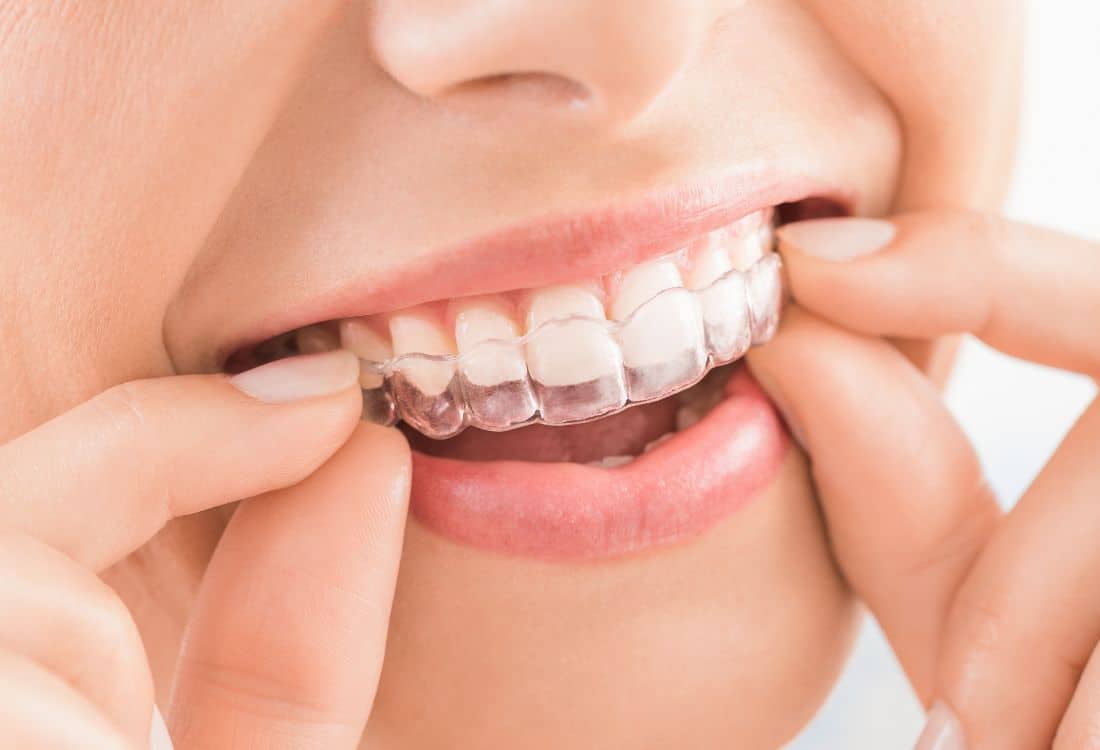 How to Take Care of Your Invisalign Aligners